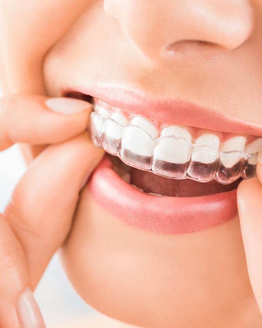Сделать прикус правильным теперь можно и без ношения пугающих брекетов