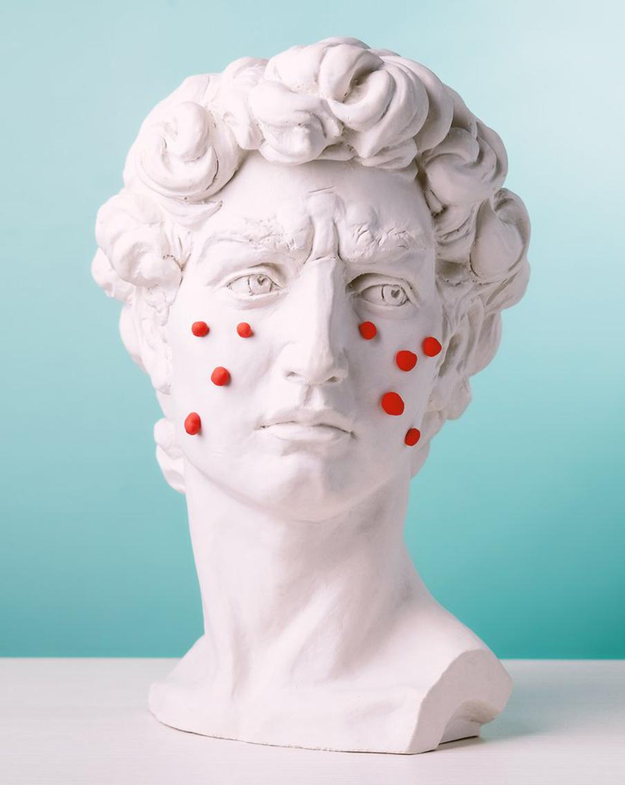 Беспокоят следы постакне? Есть косметологические способы их убрать