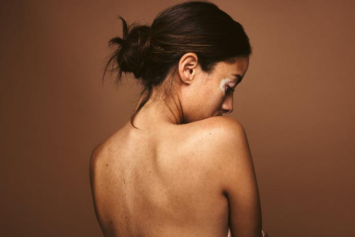 Гиперпигментация кожи: откуда берётся и как с ней бороться