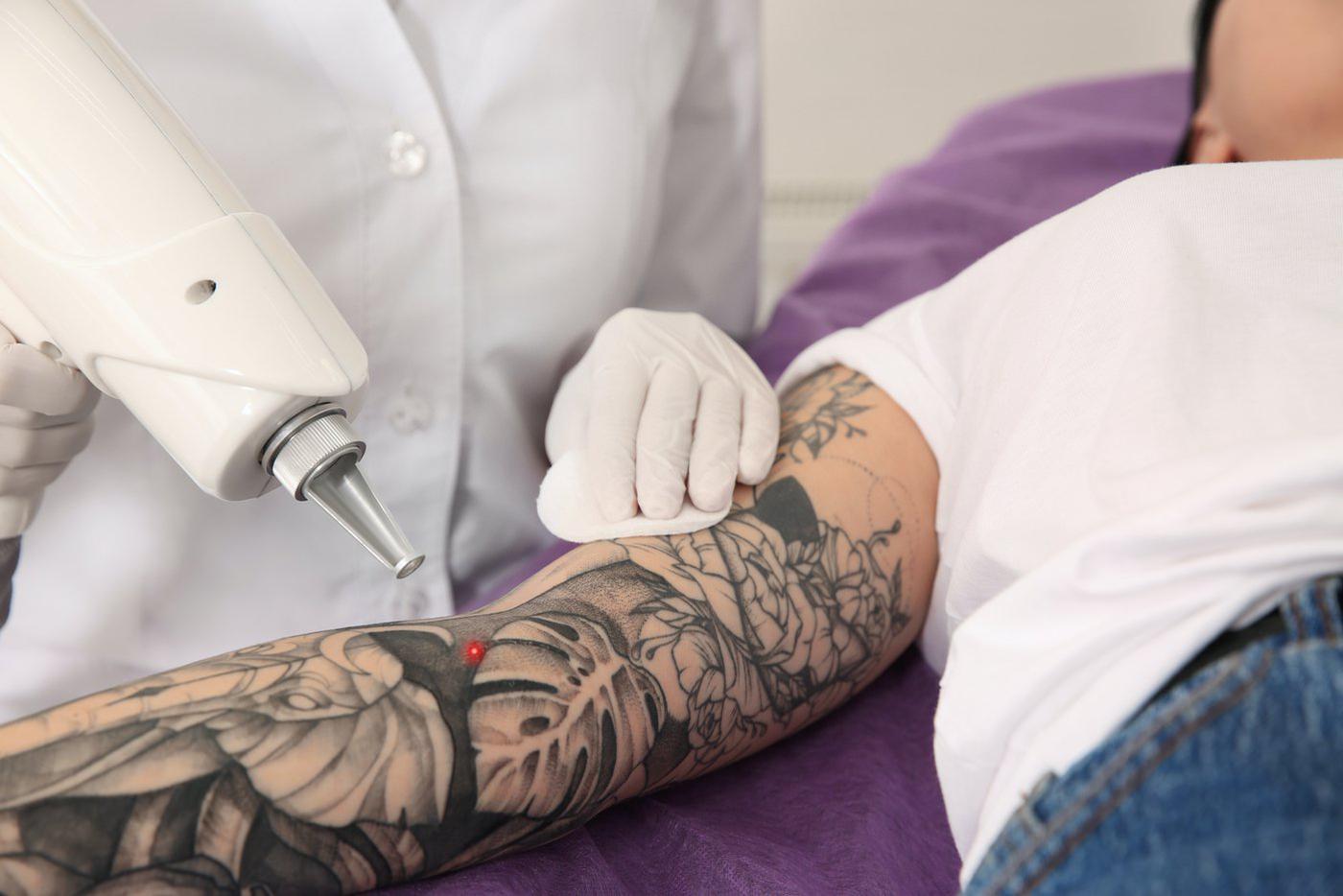 как стереть татуировку