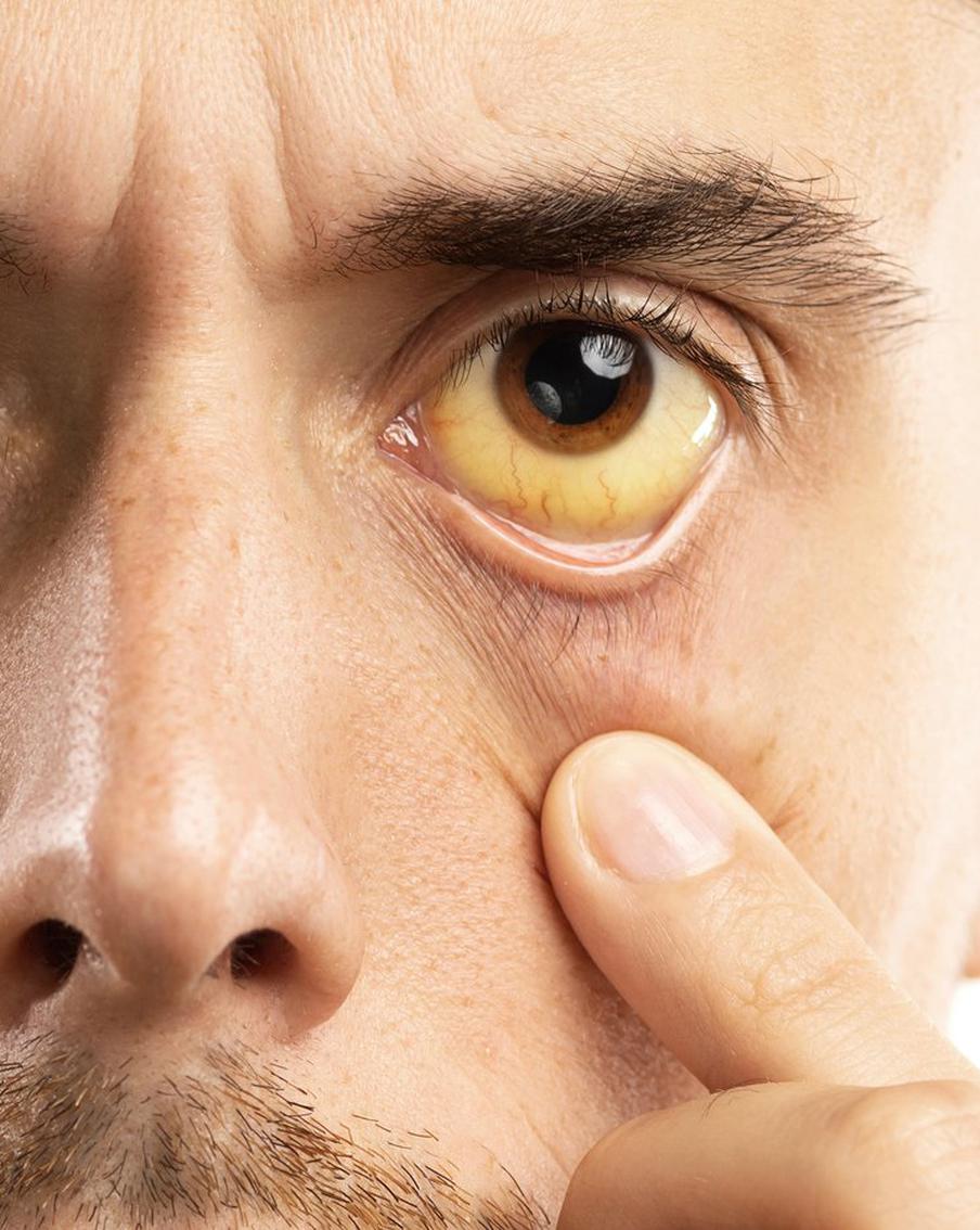 Механическая желтуха — симптом грозных проблем. Так что не стоит легкомысленно относиться к тому, что белки глаз пожелтели