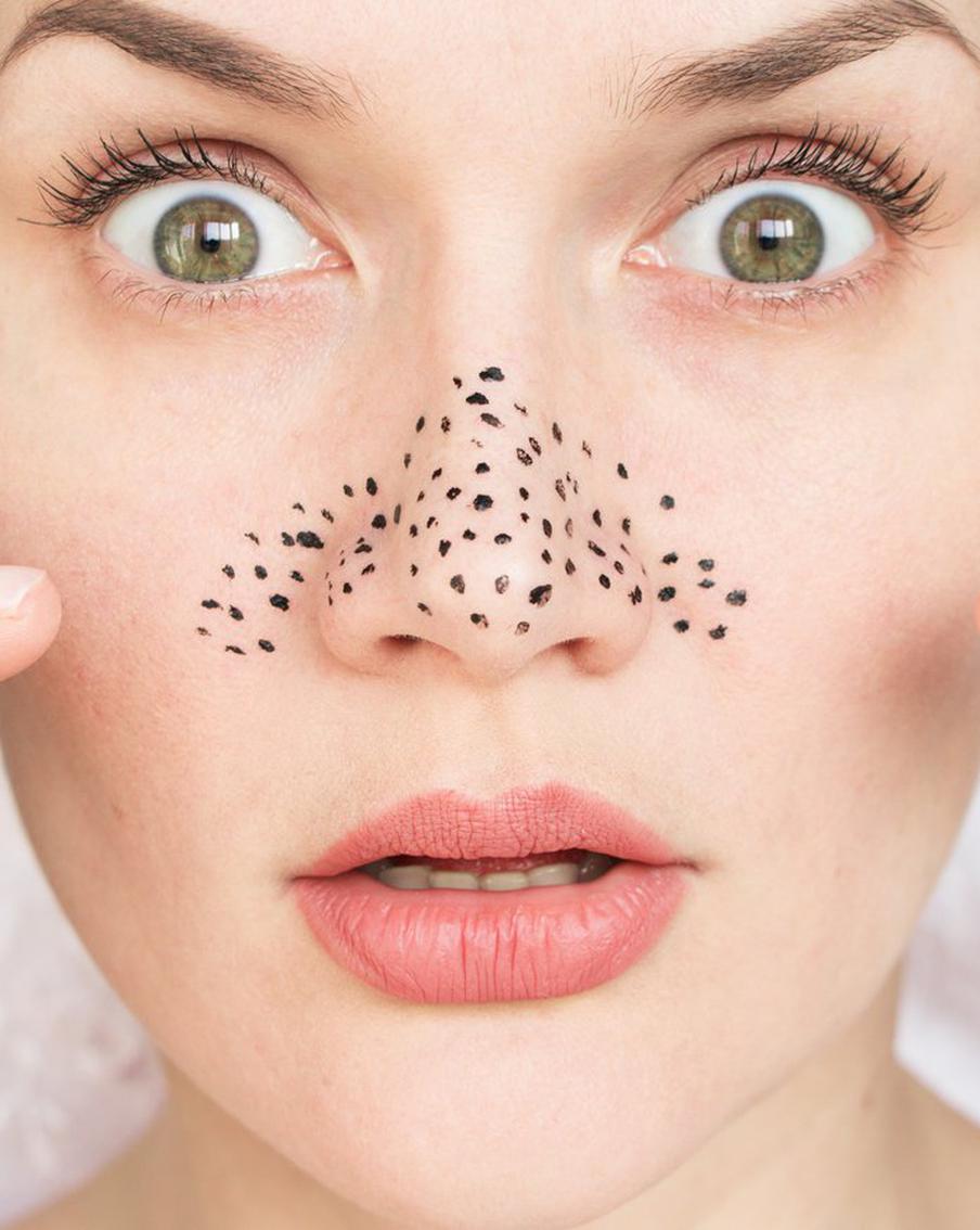 Расширенные поры часто становятся причиной развития комплексов. Не поддавайтесь, а просто принимайтесь за лечение