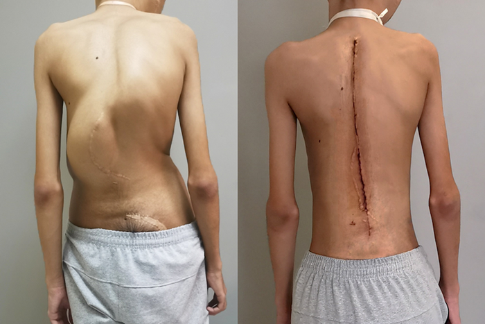 Московские врачи впервые в мире провели успешную операцию пациенту с редким генетическим заболеванием