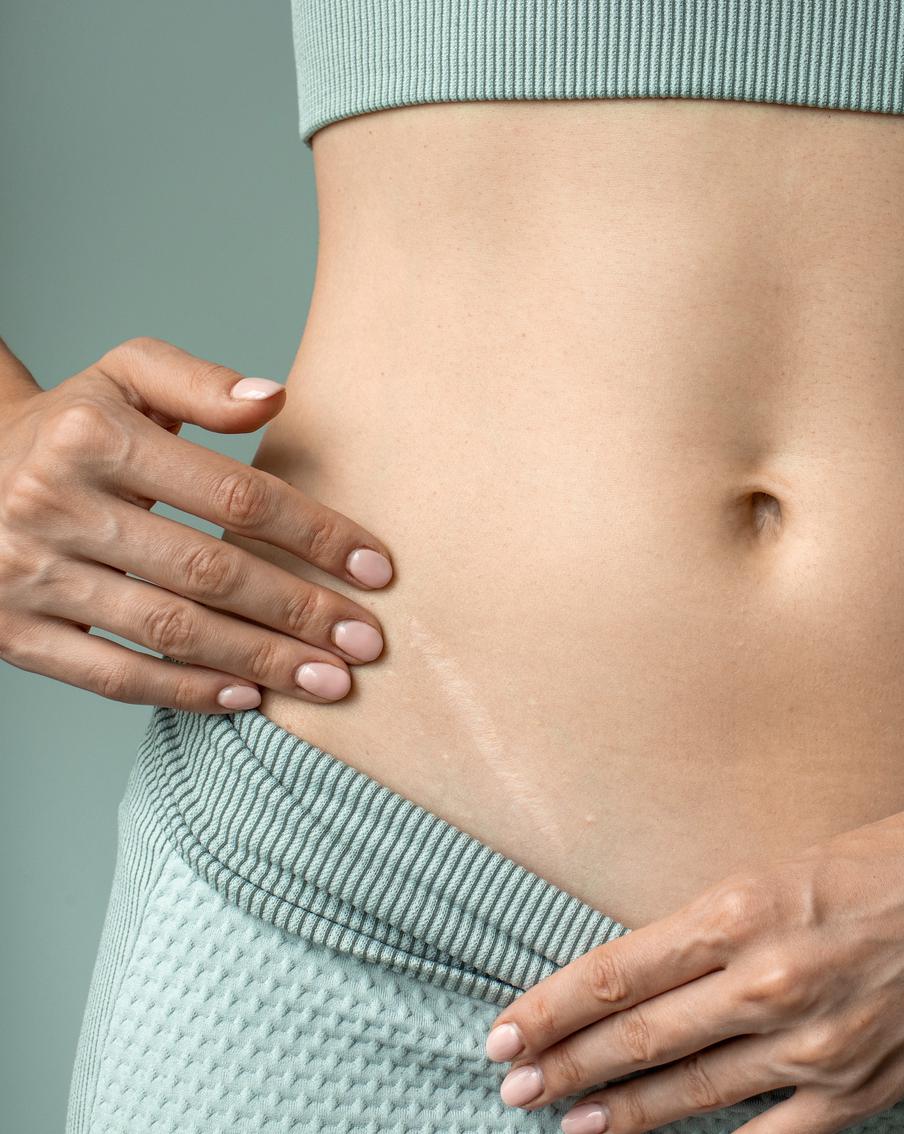 8 советов пластического хирурга помогут сделать постоперационный шрам незаметным