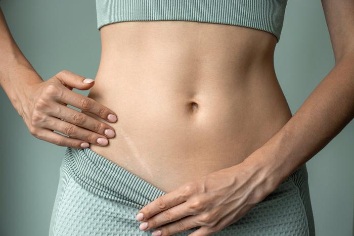 8 советов пластического хирурга помогут сделать постоперационный шрам незаметным