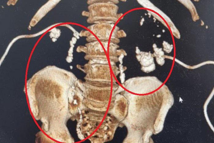 Врачи из Жуковского провели необычную операцию