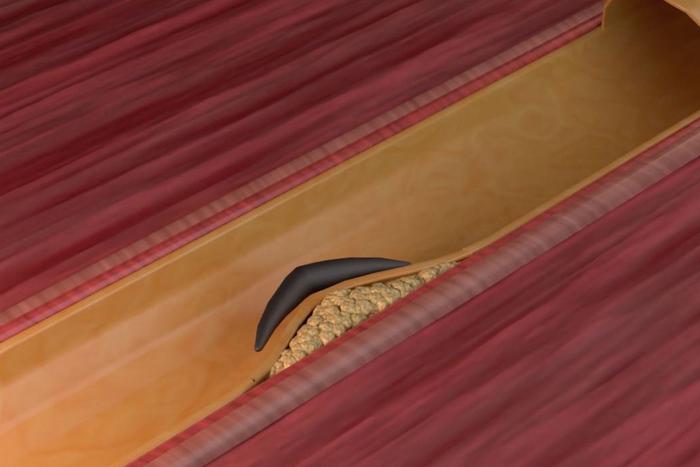 Лечение будущего скоро будет доступно всем: как студент РУДН увидел во сне ключ к излечению атеросклероза