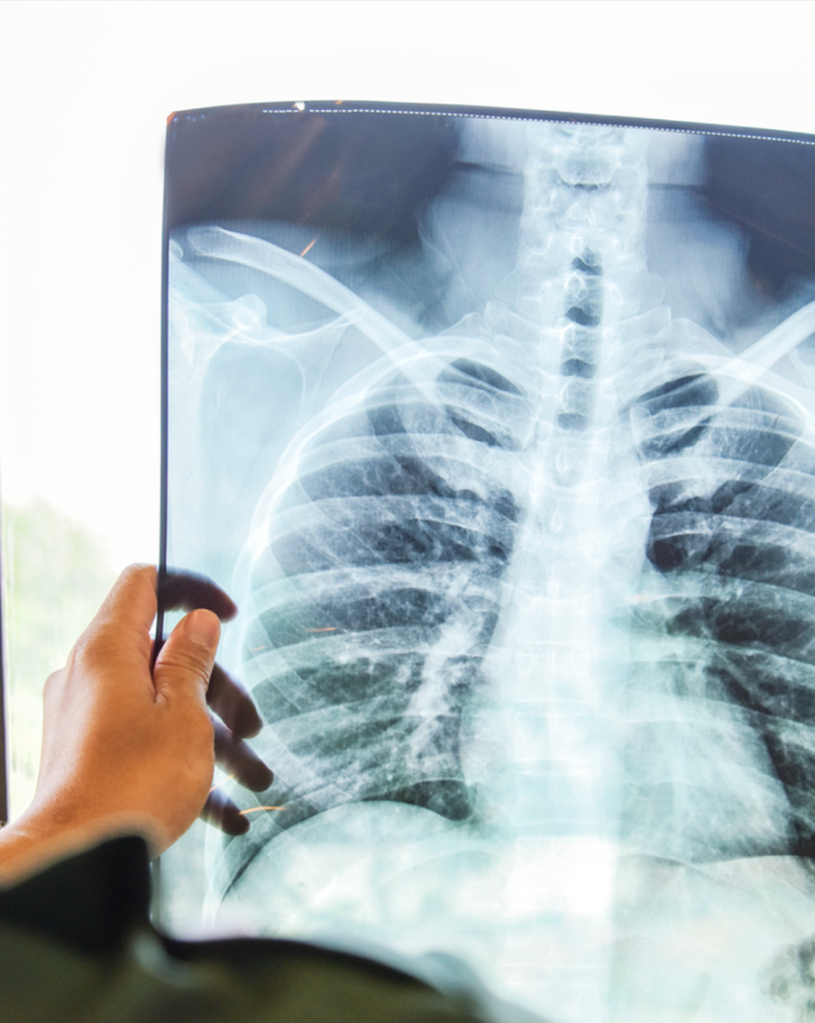 В Московской области смертность от туберкулёза снизилась в два раза