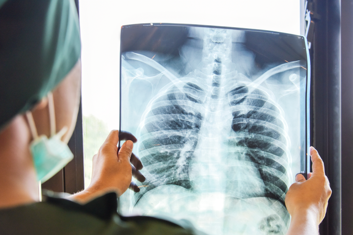 В Московской области смертность от туберкулёза снизилась в два раза