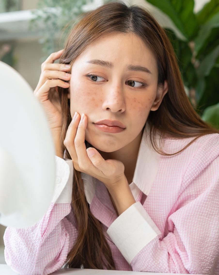 Пигментные пятна не приговор. Как от них избавиться, разбираемся вместе с экспертом