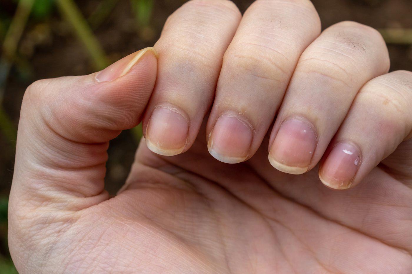 Проблема с ногтями к какому врачу обратиться. Здоровый цвет ногтей на руках. Короткие ногти болезнь.
