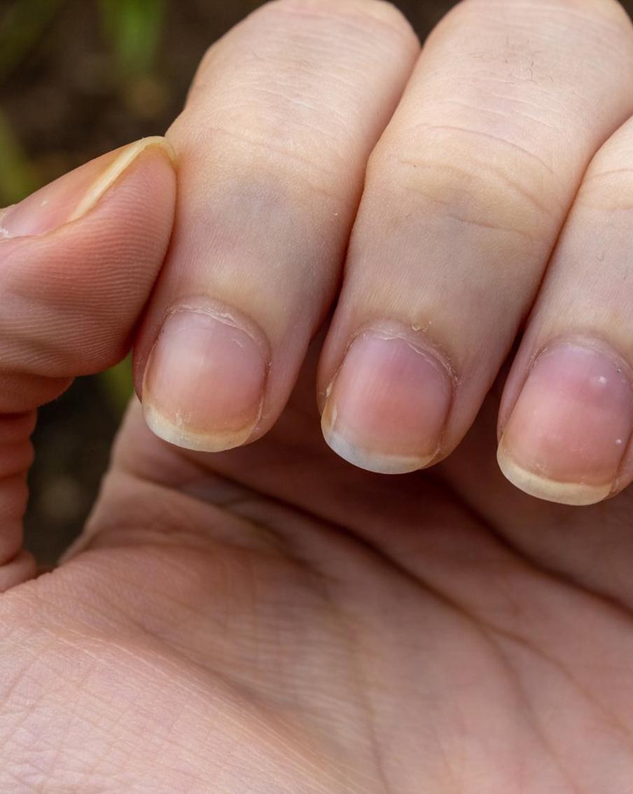 Ногти могут поменять цвет не только из-за нанесённого лака. О каких болезнях это может говорить?