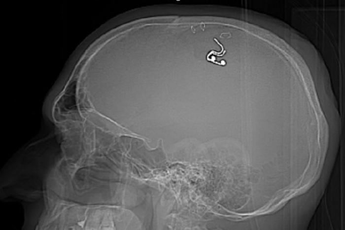 Блогер из Новосибирска, чтобы самостоятельно вживить себе чип, полтора года учился по роликам на YouTube