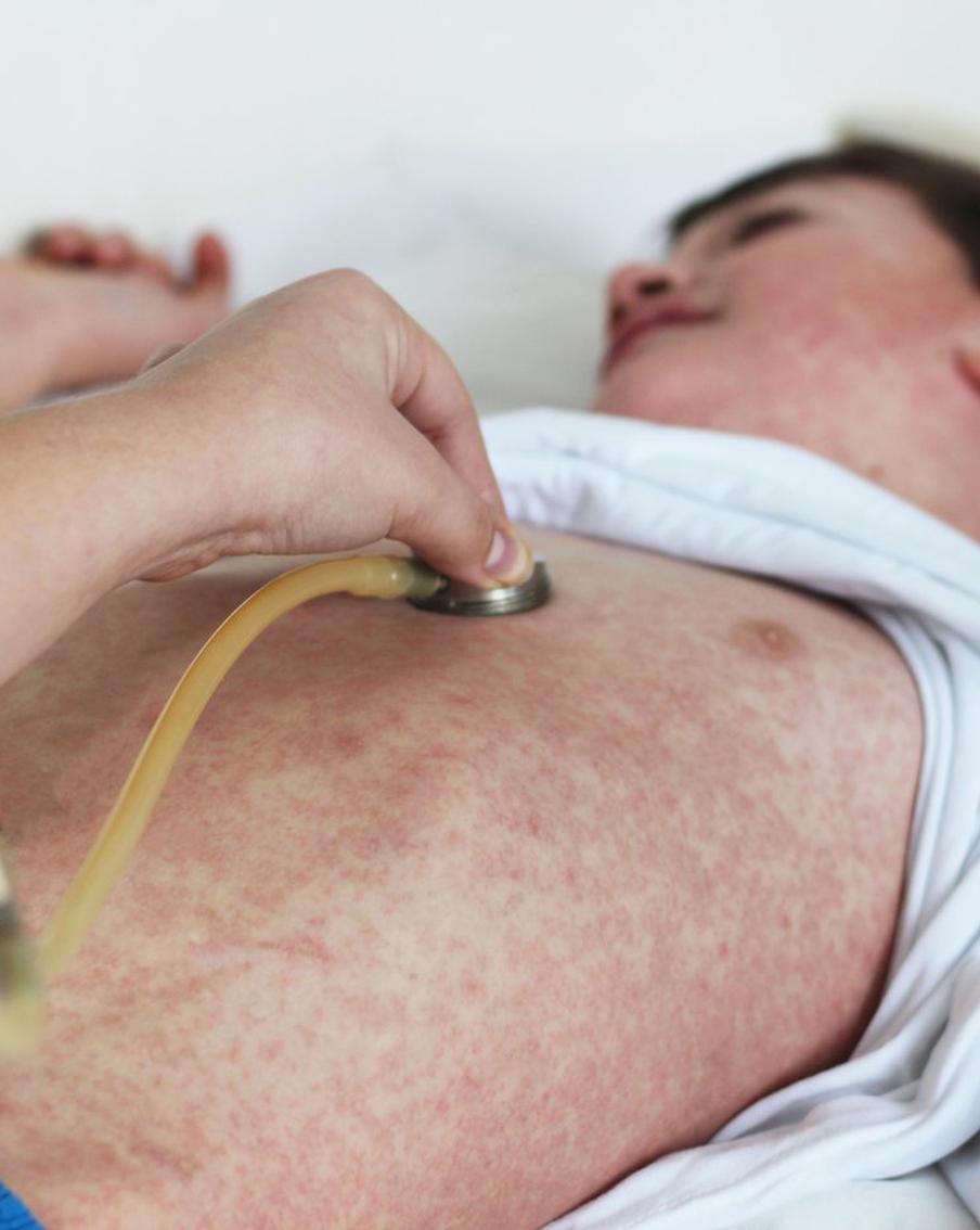 В Татарстане зафиксировали более 80 случаев заражения корью