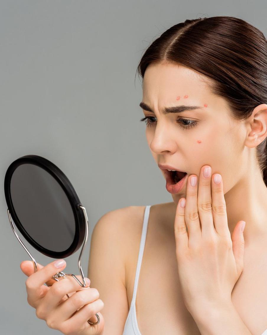 6 продуктов, вызывающих акне: от чего лучше отказаться на всю жизнь