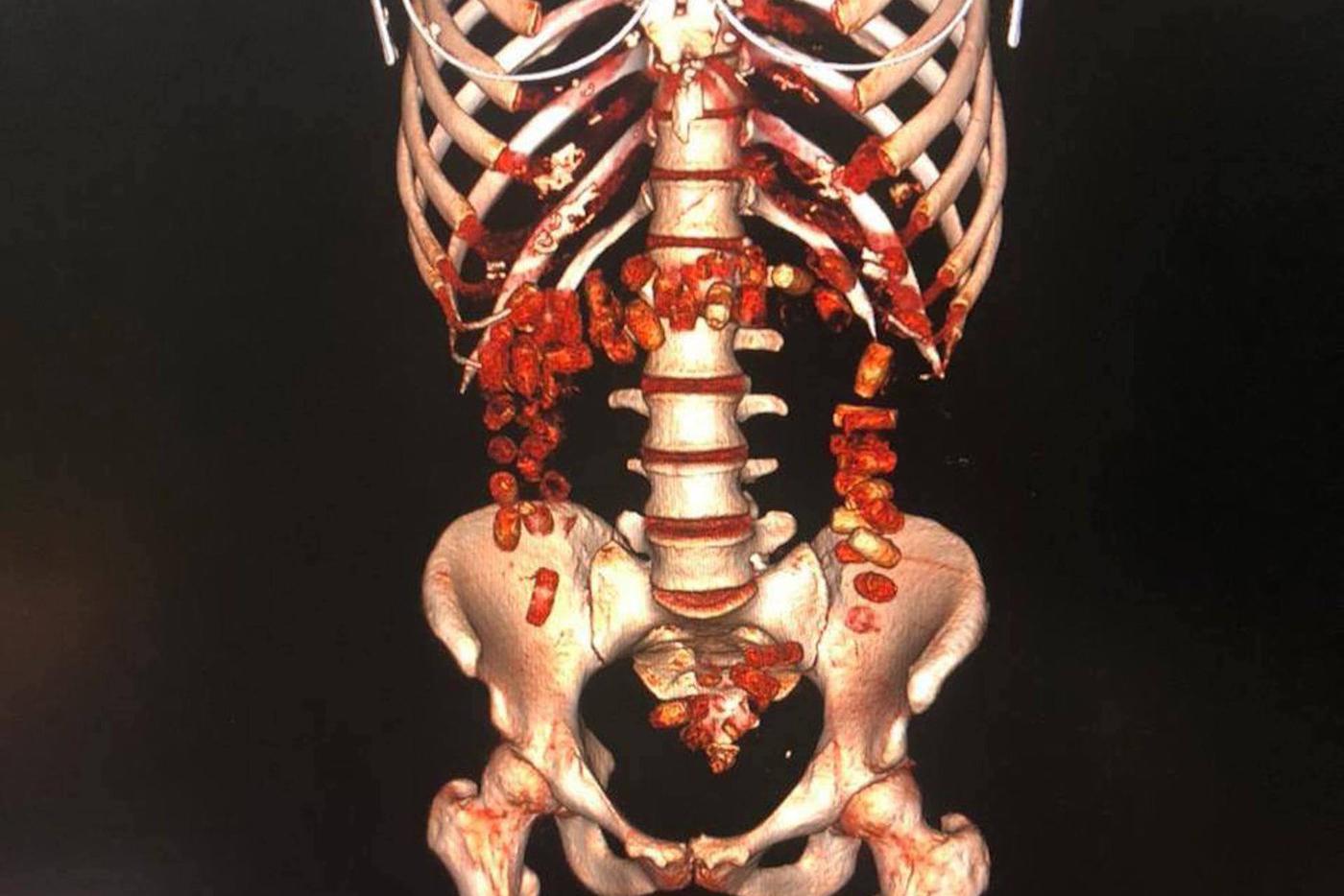 Наркотики в желудке провозят не только в кино