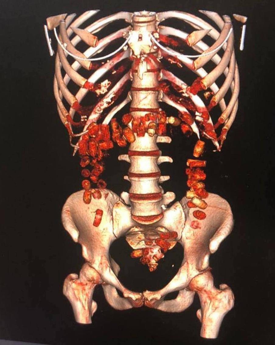 Наркотики в желудке провозят не только в кино