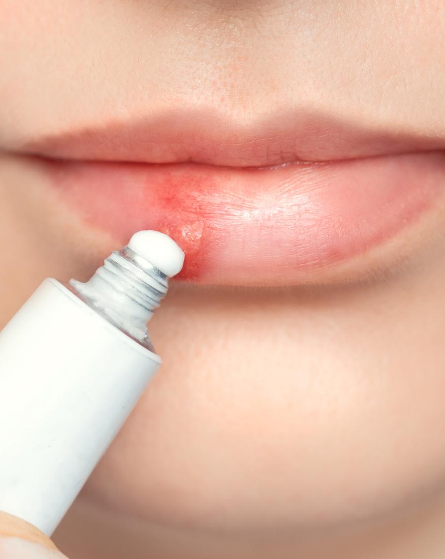 Высыпания на губе: когда нужно срочно принимать меры
