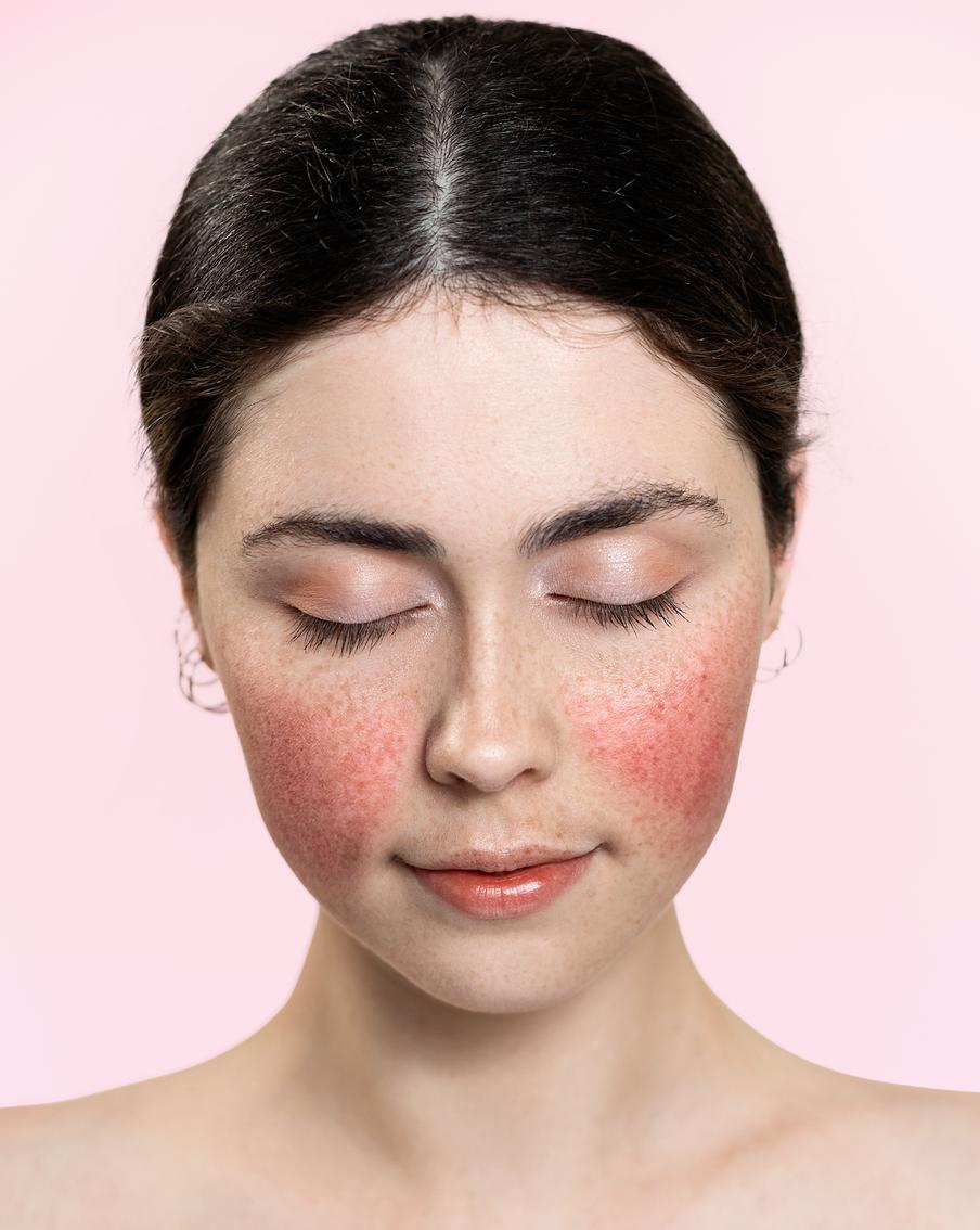 Почему появляется розацеа и как с ней бороться