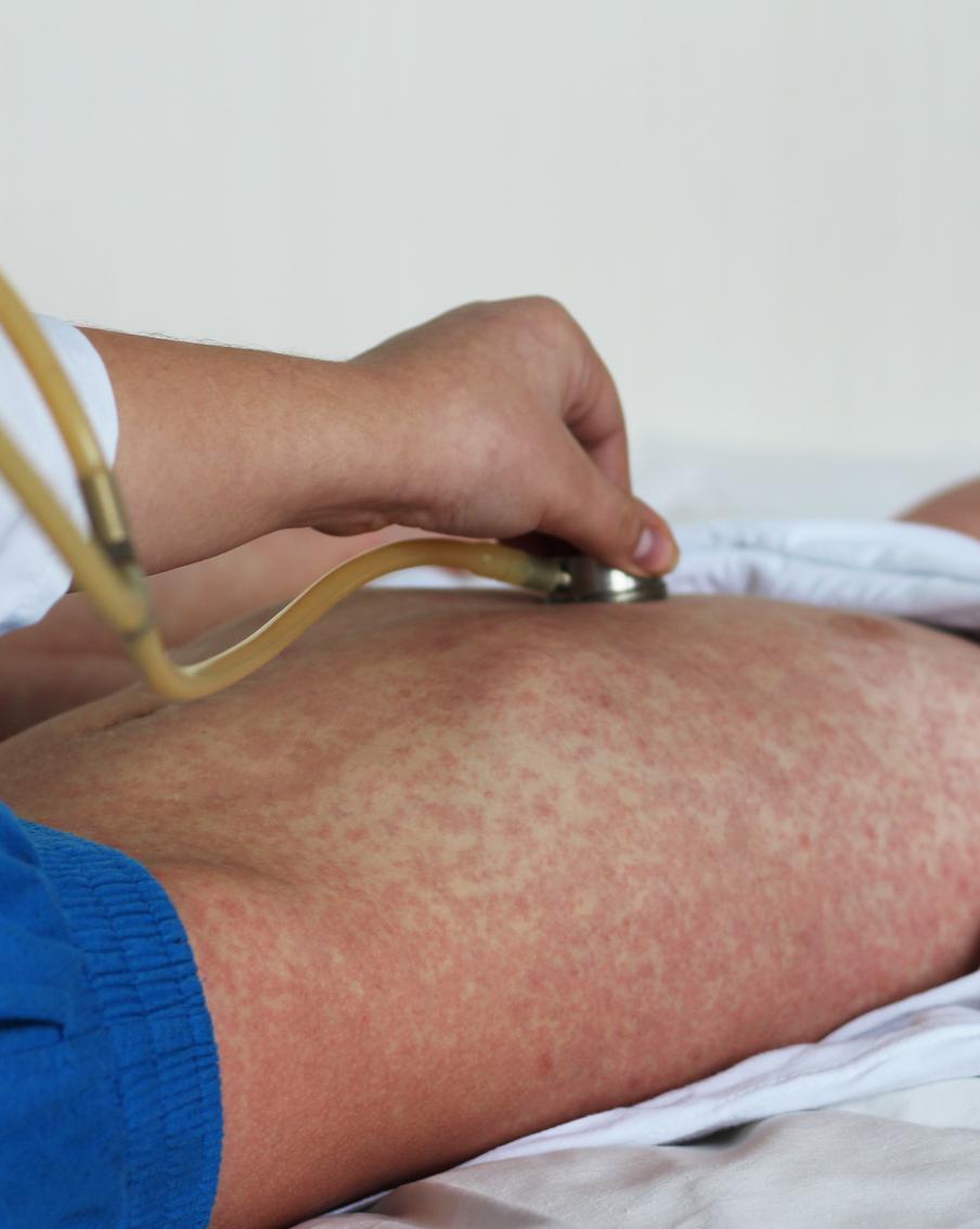 Минздрав Румынии объявил эпидемию кори