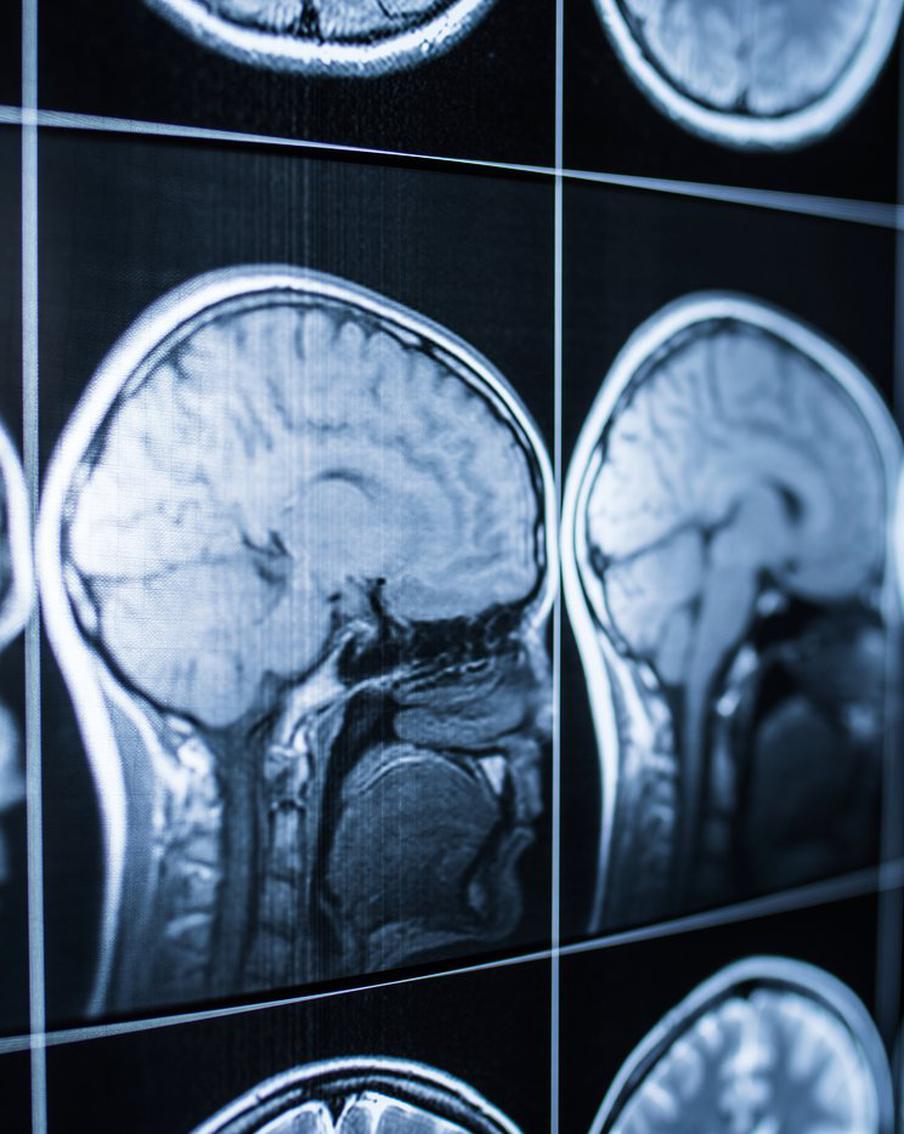 Владимир Путин оценил достижение Илона Маска, который вживил нейрочип в мозг человека