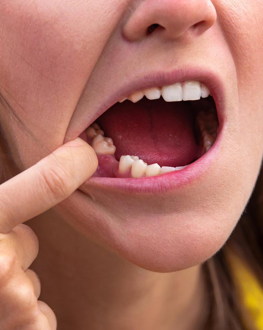 Если даже зуб выпал в незаметном для других месте, всё равно не стоит откладывать поход к врачу