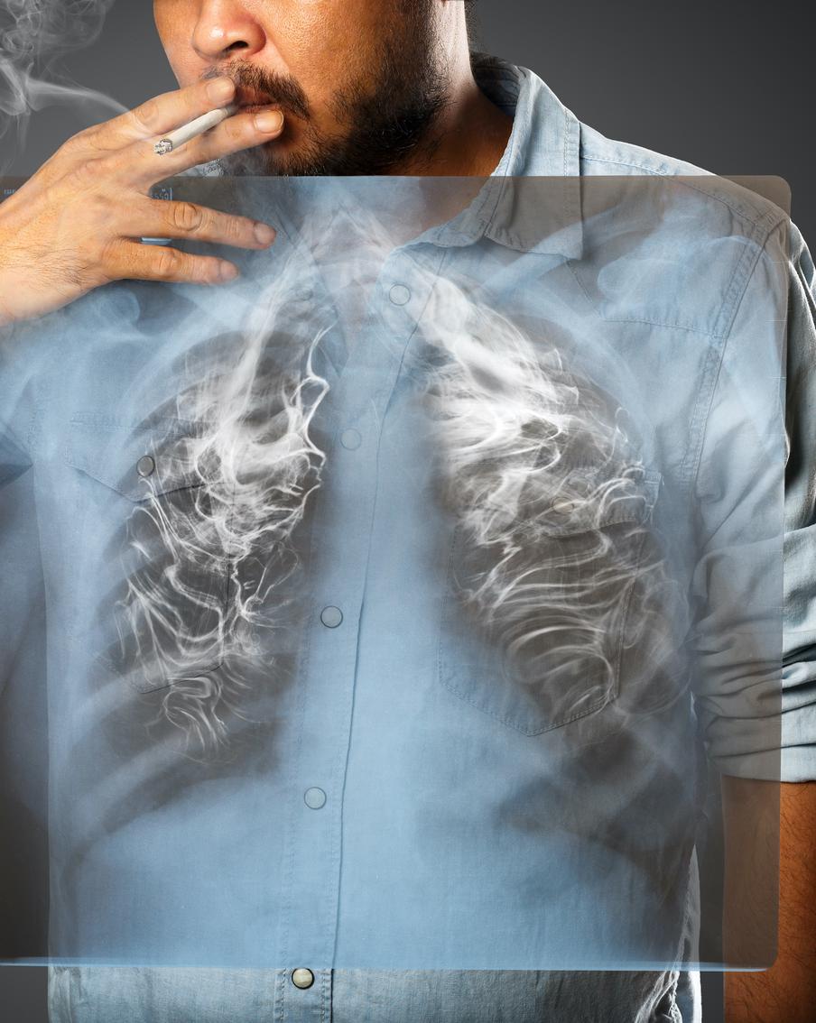 Создана вакцина от рака лёгких. Испытания уже начались