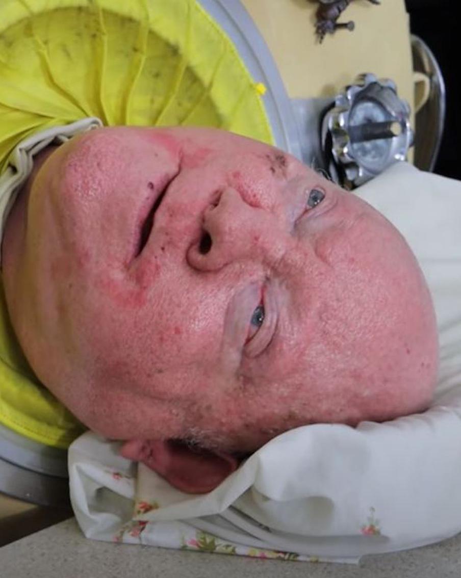 Умер Пол Александер, который прожил в капсуле "железные лёгкие" более 70 лет