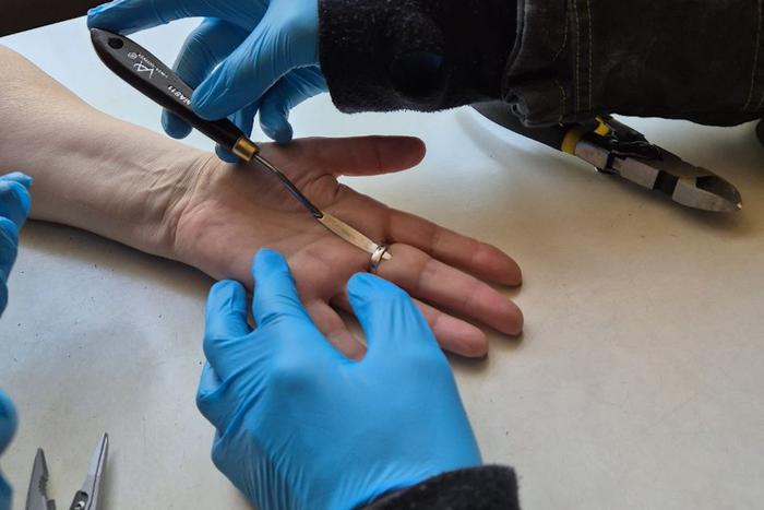 Москвичка носила серебряное кольцо до тех пор, пока не опух палец