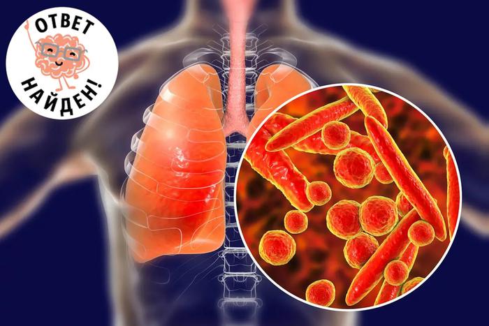 Микоплазменная пневмония. Болезнь, которая "прогуливается"