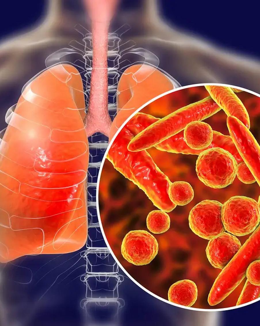 Микоплазменная пневмония. Болезнь, которая "прогуливается"