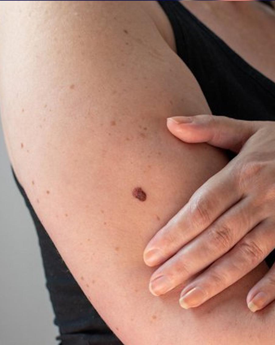 Взять на мушку: чем могут быть опасны родинки