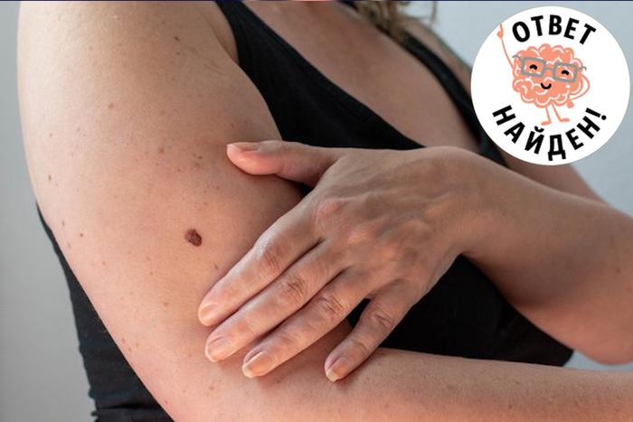 Взять на мушку: чем могут быть опасны родинки