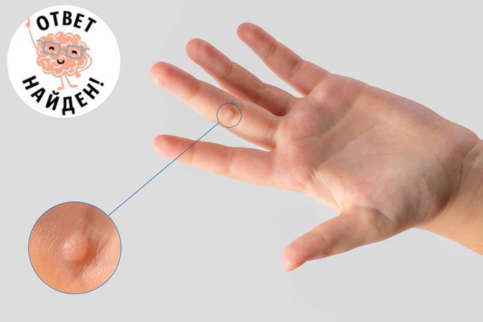 Вирус папилломы человека: чем опасна проблема и как предотвратить её появление