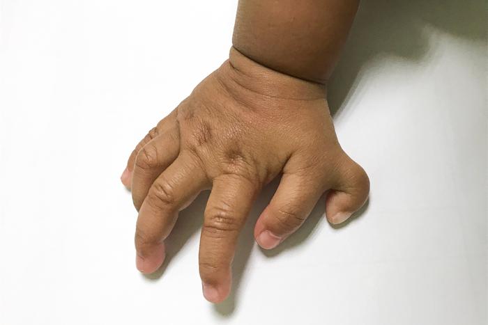 Знать как свои... шесть пальцев. Что такое полидактилия