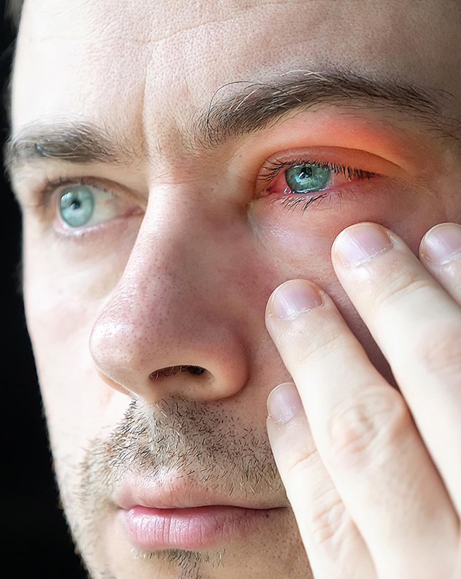 Как не стать кротом: почему конъюнктивит нужно лечить вовремя