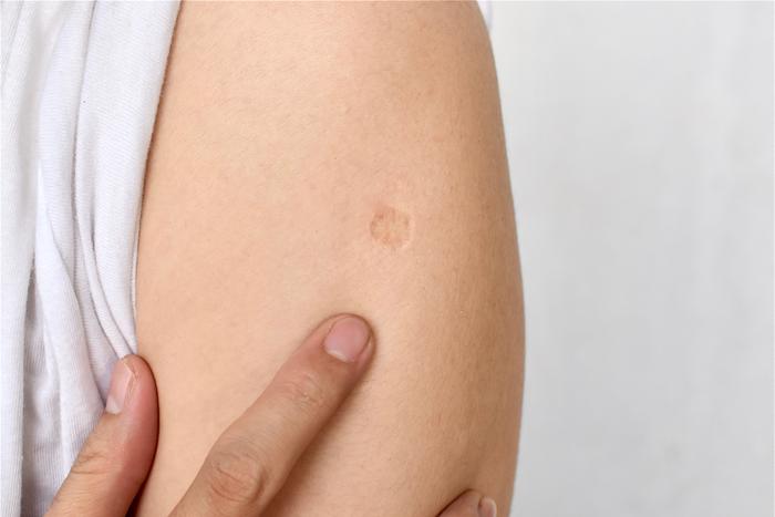 На российскую вакцину от туберкулёза возлагают большие надежды