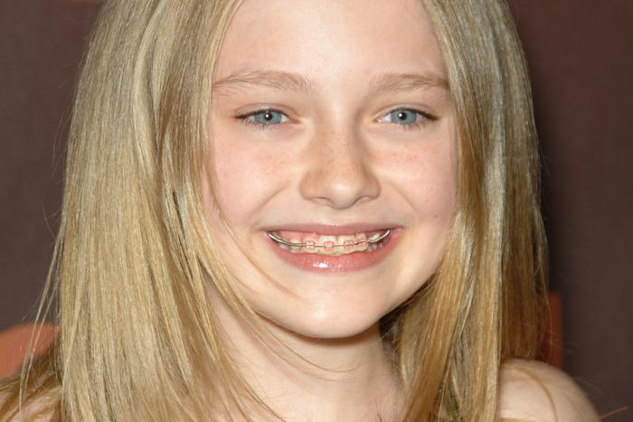 Какие брекеты выбрать: незаметные и хрупкие или тяжёлые, но надёжные