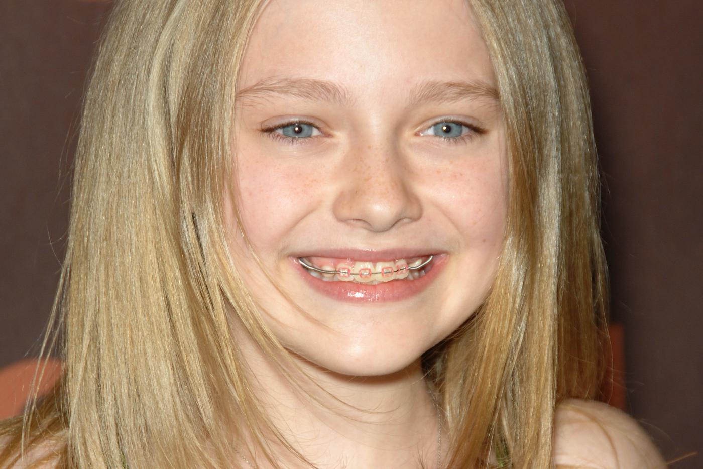 Какие брекеты выбрать: незаметные и хрупкие или тяжёлые, но надёжные