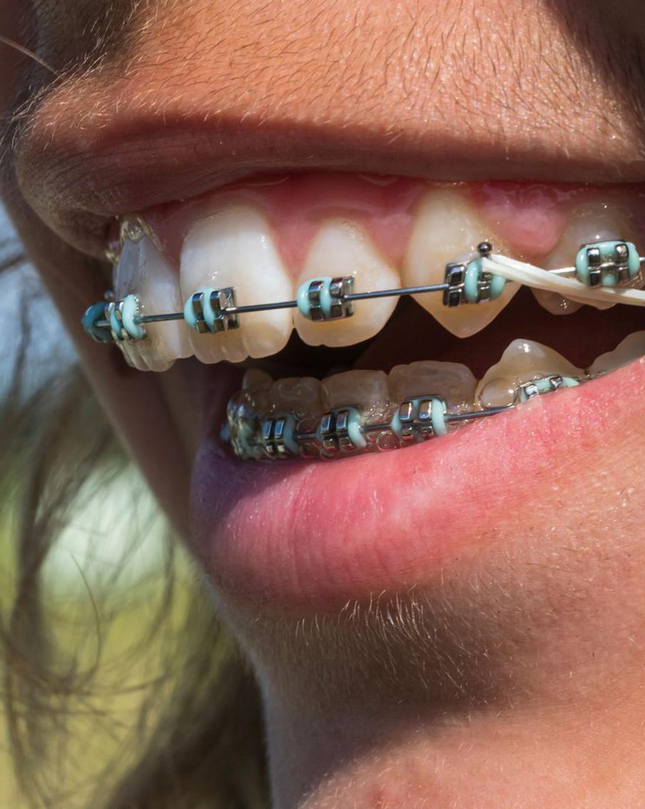 Чем вреден для человека неправильный прикус