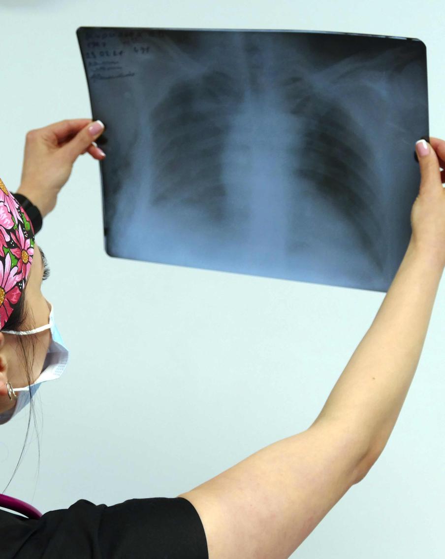 В России зафиксировали рост заболеваемости пневмониями