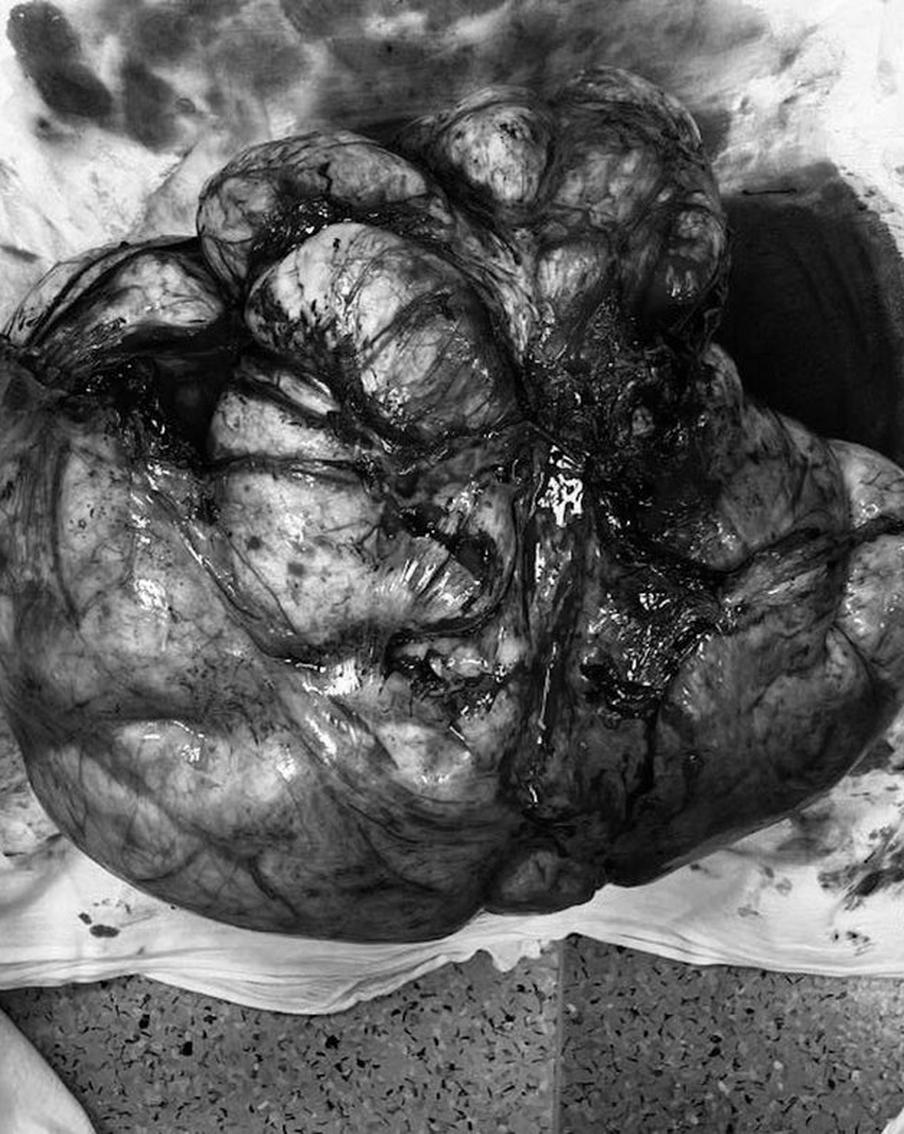 Опухоль размером с тыкву: подмосковные врачи спасли от смерти 66-летнюю женщину