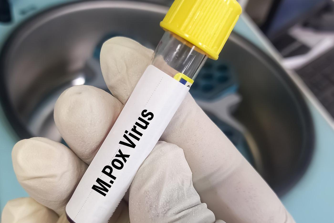 Роспотребнадзор рассказал о вероятности появления оспы обезьян в России