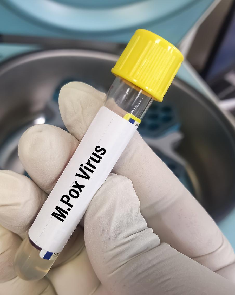 Роспотребнадзор рассказал о вероятности появления оспы обезьян в России