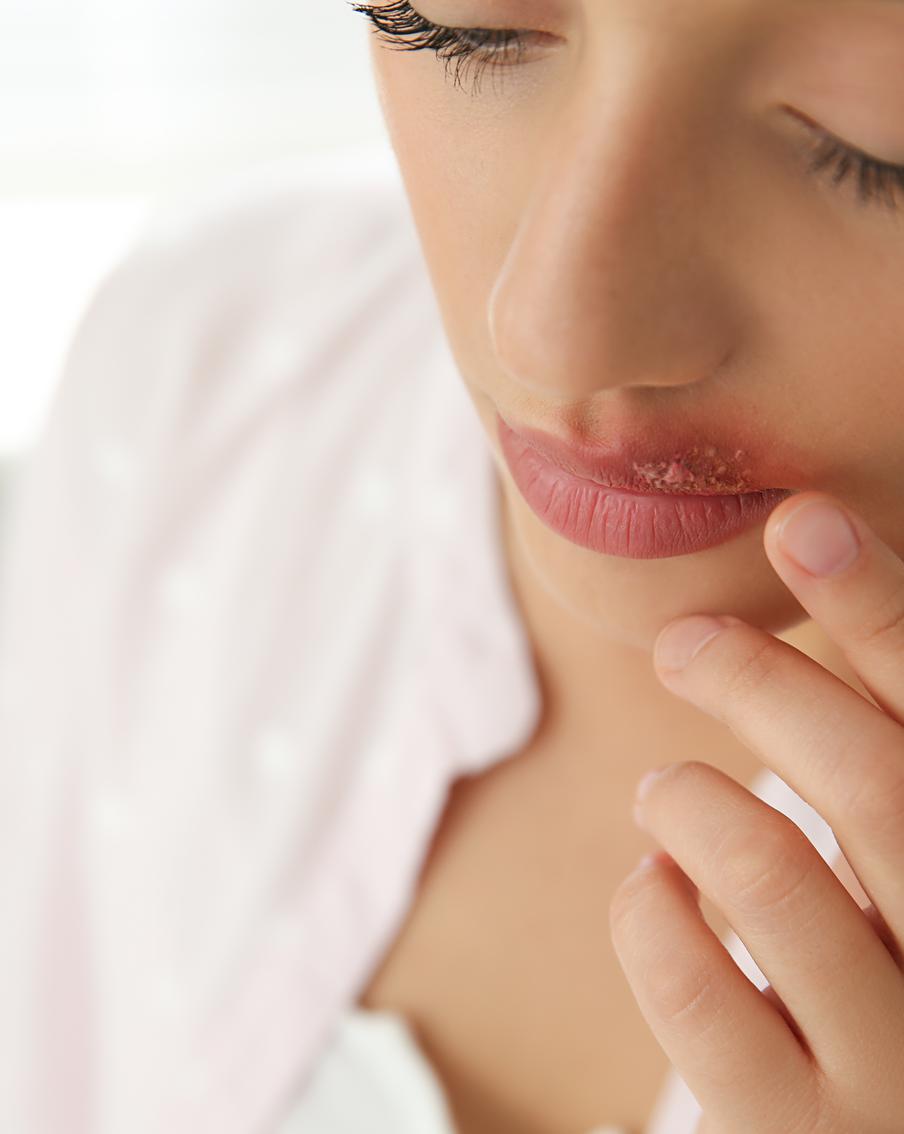 90% взрослого населения – носители вируса герпеса. Многие даже не подозревают об этом