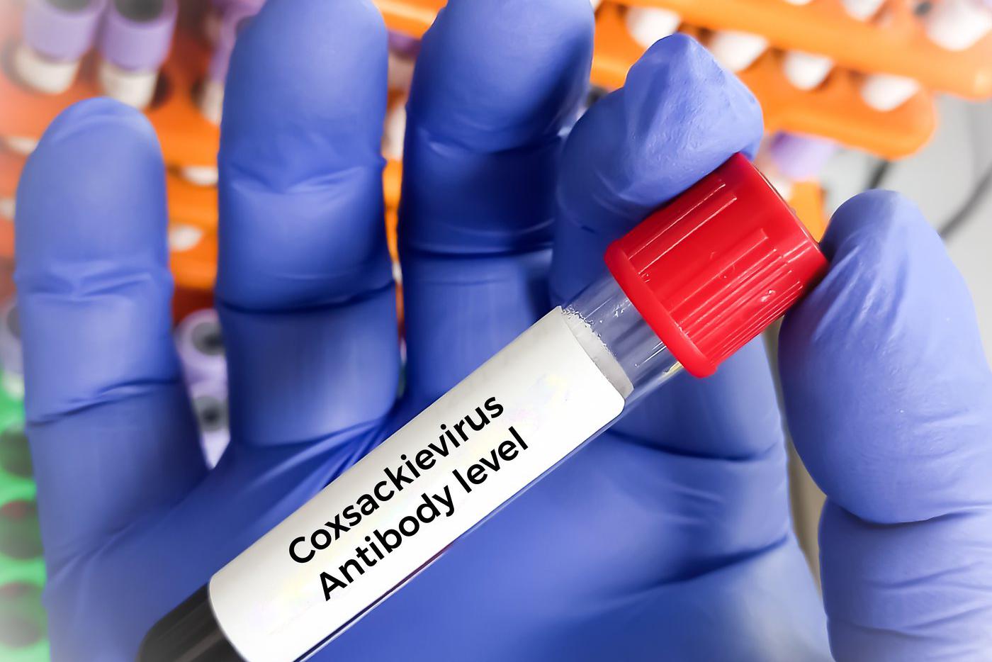 Россиян отговаривают от отдыха в Турции из-за вируса, от которого "пухнут мозги"