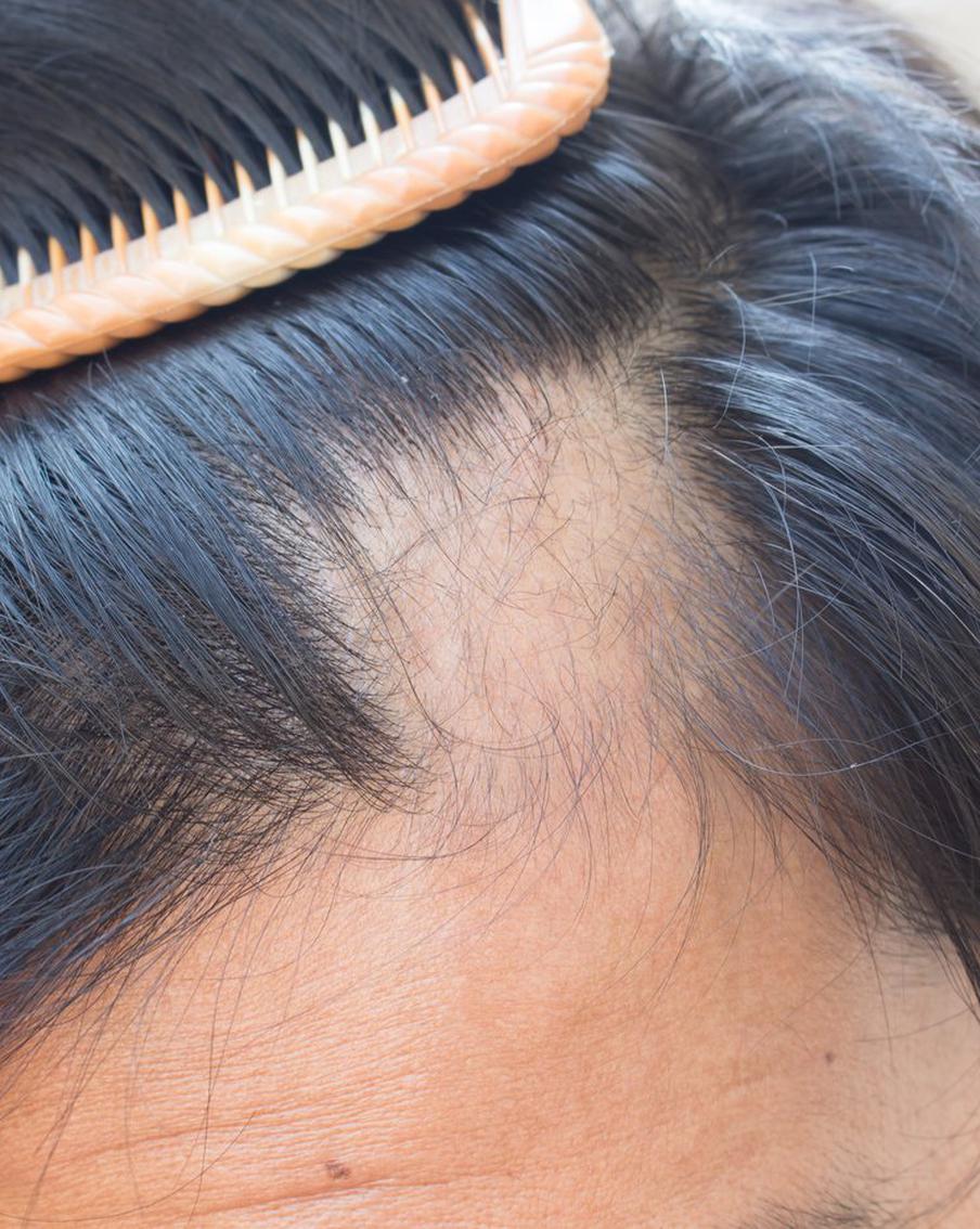 Подростковое облысение не связано с погодой: Metro выяснило, как и почему у молодёжи возникает алопеция