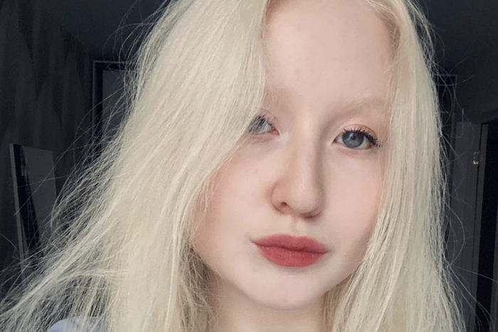 "Меня называли девочка-монстр": россиянка-альбинос рассказала о преодолении