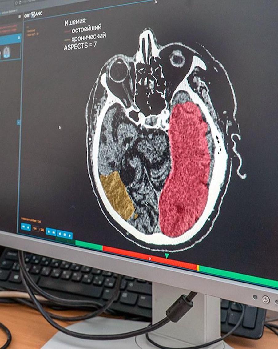 Сергей Собянин рассказал о тестировании уникальной ИИ-системы для диагностики инсульта