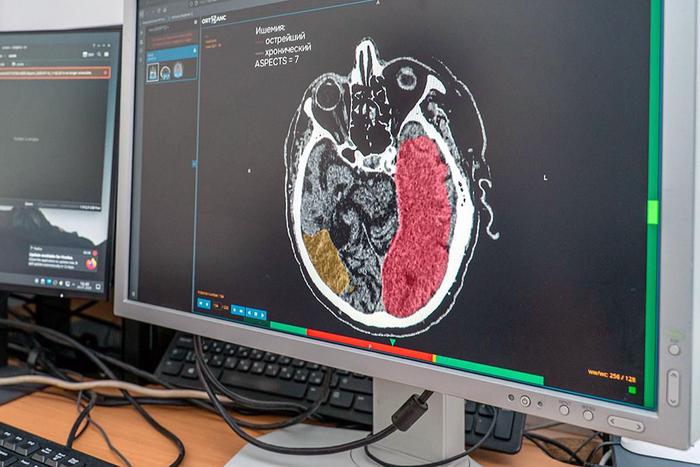 Сергей Собянин рассказал о тестировании уникальной ИИ-системы для диагностики инсульта